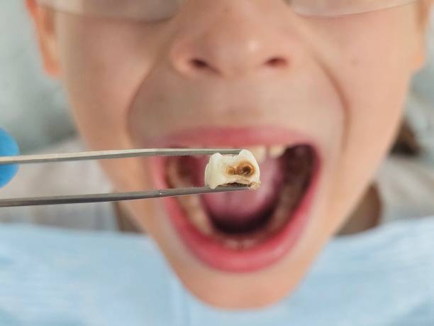 Best Same-Day Emergency Dental Services in Livingston, TN